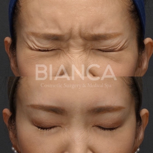 ボトックスで失敗を防ぐには？原因と対策を医師が解説